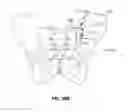 Fig. 86 - Systems and methods for fusing a sacroiliac joint and anchoring an orthopedic appliance