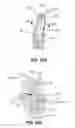Fig. 87 - Systems and methods for fusing a sacroiliac joint and anchoring an orthopedic appliance