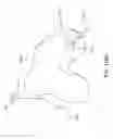 Fig. 83 - Method for repairing focal defects in tissue of a patient