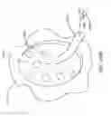 Fig. 84 - Method for repairing focal defects in tissue of a patient