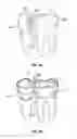 Fig. 09 - Dental devices and methods for treating one or more teeth