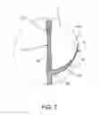 Fig. 09 - Prosthetic heart valve formation