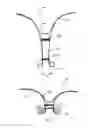 Fig. 02 - Ventricular volume reduction