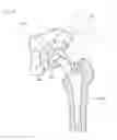 Fig. 09 - Artificial hip joint stem, stem inserter, artificial hip joint system including them, and artificial hip joint