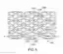 Fig. 06 - Method of treatment with a bioabsorbable stent with time dependent structure and properties and regio-selective degradation