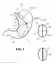 Fig. 06 - MULTI-METHOD AND MULTI-APPARATUS FOR TREATING OBESITY