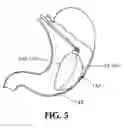 Fig. 08 - MULTI-METHOD AND MULTI-APPARATUS FOR TREATING OBESITY