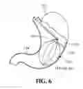 Fig. 09 - MULTI-METHOD AND MULTI-APPARATUS FOR TREATING OBESITY