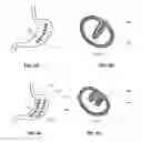 Fig. 04 - METHODS AND DEVICES FOR  REDUCING GASTRIC VOLUME