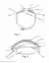 Fig. 02 - Capsular Ring