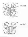 Fig. 16 - Apparatus and methods for dilating and modifying ostia of paranasal sinuses and other intranasal or paranasal structures