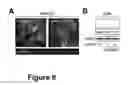 Fig. 09 - Simultaneous detection of cannibalism and senescence as prognostic marker for cancer