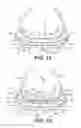 Fig. 09 - Microprocessor control of bladders in footwear soles with internal flexibility sipes
