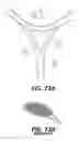 Fig. 52 - Microprocessor control of bladders in footwear soles with internal flexibility sipes