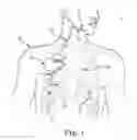 Fig. 02 - METHOD OF TREATING SLEEP DISORDERED BREATHING