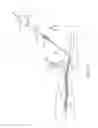 Fig. 11 - Systems and methods for treatment of perforator veins for venous insufficiency