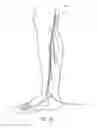 Fig. 15 - Systems and methods for treatment of perforator veins for venous insufficiency