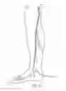 Fig. 19 - Systems and methods for treatment of perforator veins for venous insufficiency