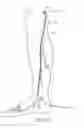 Fig. 20 - Systems and methods for treatment of perforator veins for venous insufficiency