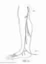 Fig. 22 - Systems and methods for treatment of perforator veins for venous insufficiency
