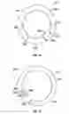 Fig. 12 - Dilation system and method
