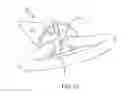 Fig. 29 - Left atrial appendage treatment systems and methods