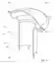 Fig. 18 - VESSEL OCCLUSION DEVICES, KITS AND METHODS