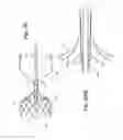 Fig. 16 - ENDOVASCULAR OCCLUSION DEVICE WITH HEMODYNAMICALLY ENHANCED SEALING AND ANCHORING