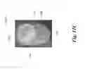Fig. 38 - ENDOVASCULAR OCCLUSION DEVICE WITH HEMODYNAMICALLY ENHANCED SEALING AND ANCHORING