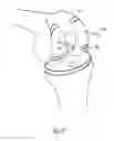 Fig. 08 - Revision joint replacement device and method