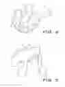 Fig. 04 - Intra-operatively adjustable cutting guide