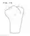 Fig. 10 - Intra-operatively adjustable cutting guide
