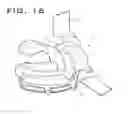 Fig. 11 - Intra-operatively adjustable cutting guide