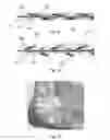 Fig. 10 - Undercutting system for use in conjunction with sacroiliac fusion