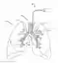Fig. 01 - Non-invasive and minimally invasive denervation methods and systems for performing the same
