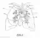 Fig. 02 - Non-invasive and minimally invasive denervation methods and systems for performing the same