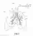 Fig. 03 - Non-invasive and minimally invasive denervation methods and systems for performing the same