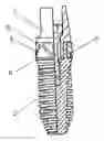 Fig. 01 - Dental implant