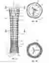 Fig. 05 - Esophageal stent with valve