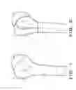 Fig. 02 - Orthopedic prosthesis with suture anchor features