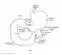 Fig. 02 - Transpyloric anchoring