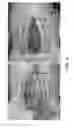 Fig. 03 - Negative pressure wound closure device