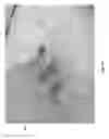 Fig. 74 - Negative pressure wound closure device