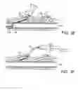 Fig. 07 - Vascular access device and guiding portion