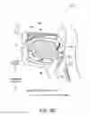 Fig. 11 - Method and apparatus for treating sleep apnea
