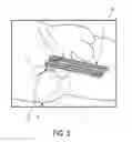 Fig. 04 - Determination apparatus for determining the pose and shape of an introduction element