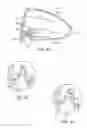 Fig. 25 - Golf club head with flexure
