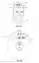 Fig. 02 - Cranial implant
