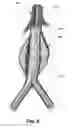 Fig. 09 - DETECTING ENDOLEAKS ASSOCIATED WITH ANEURYSM REPAIR