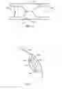 Fig. 12 - BONE TISSUE FIXATION DEVICE AND METHOD